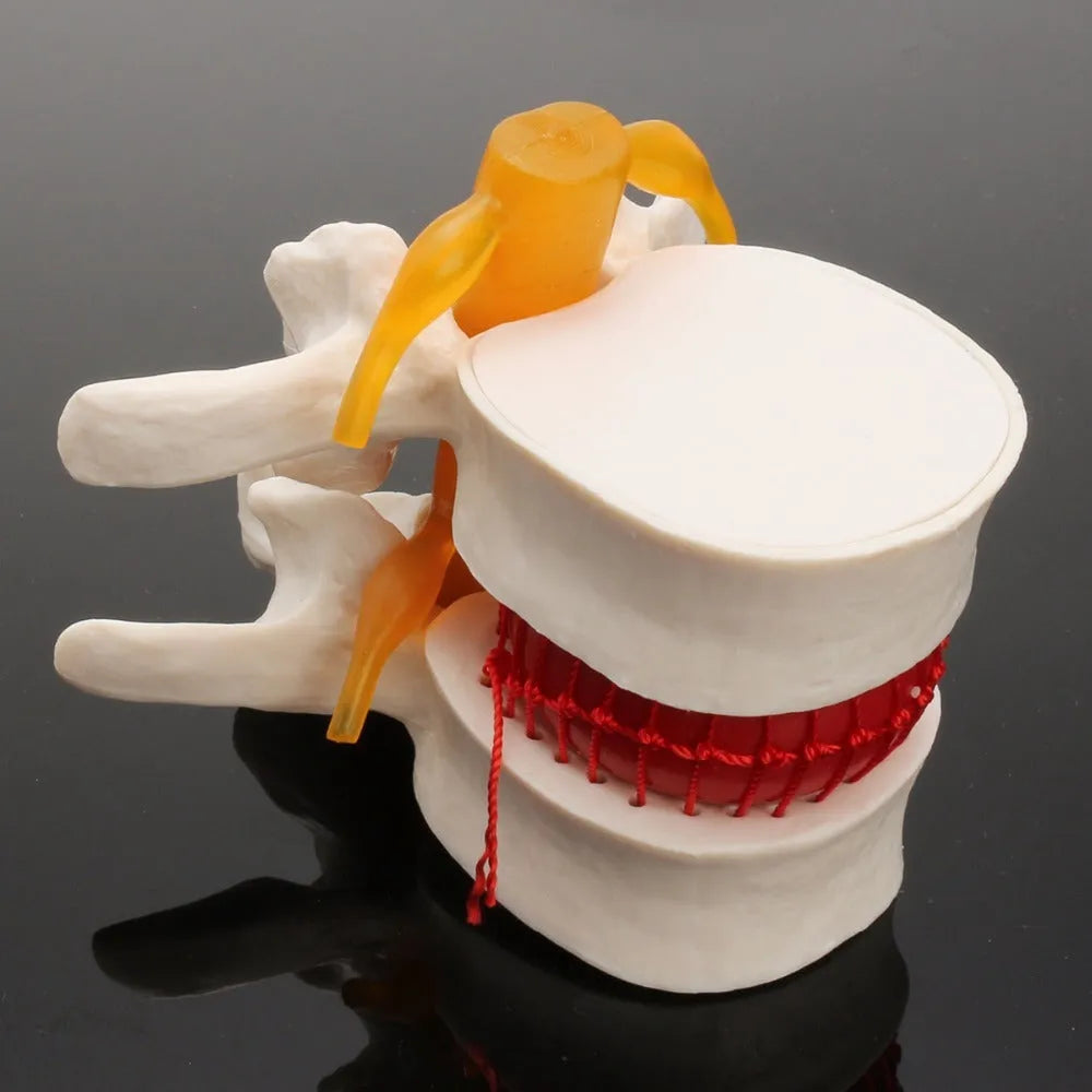 White PVC intervertebral disc herniation demonstration model for medical education