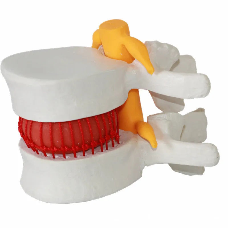White PVC intervertebral disc herniation demonstration model for medical education