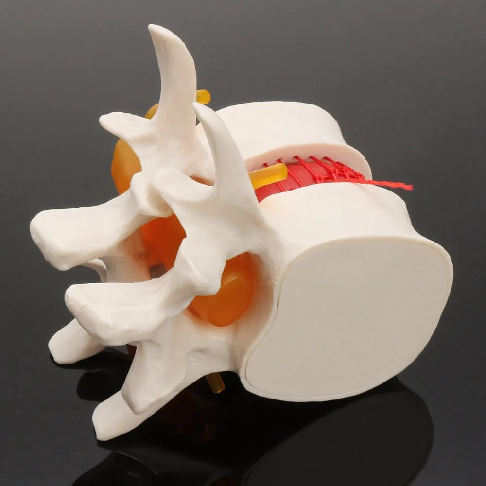 White PVC intervertebral disc herniation demonstration model for medical education