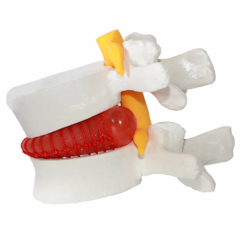 White PVC intervertebral disc herniation demonstration model for medical education
