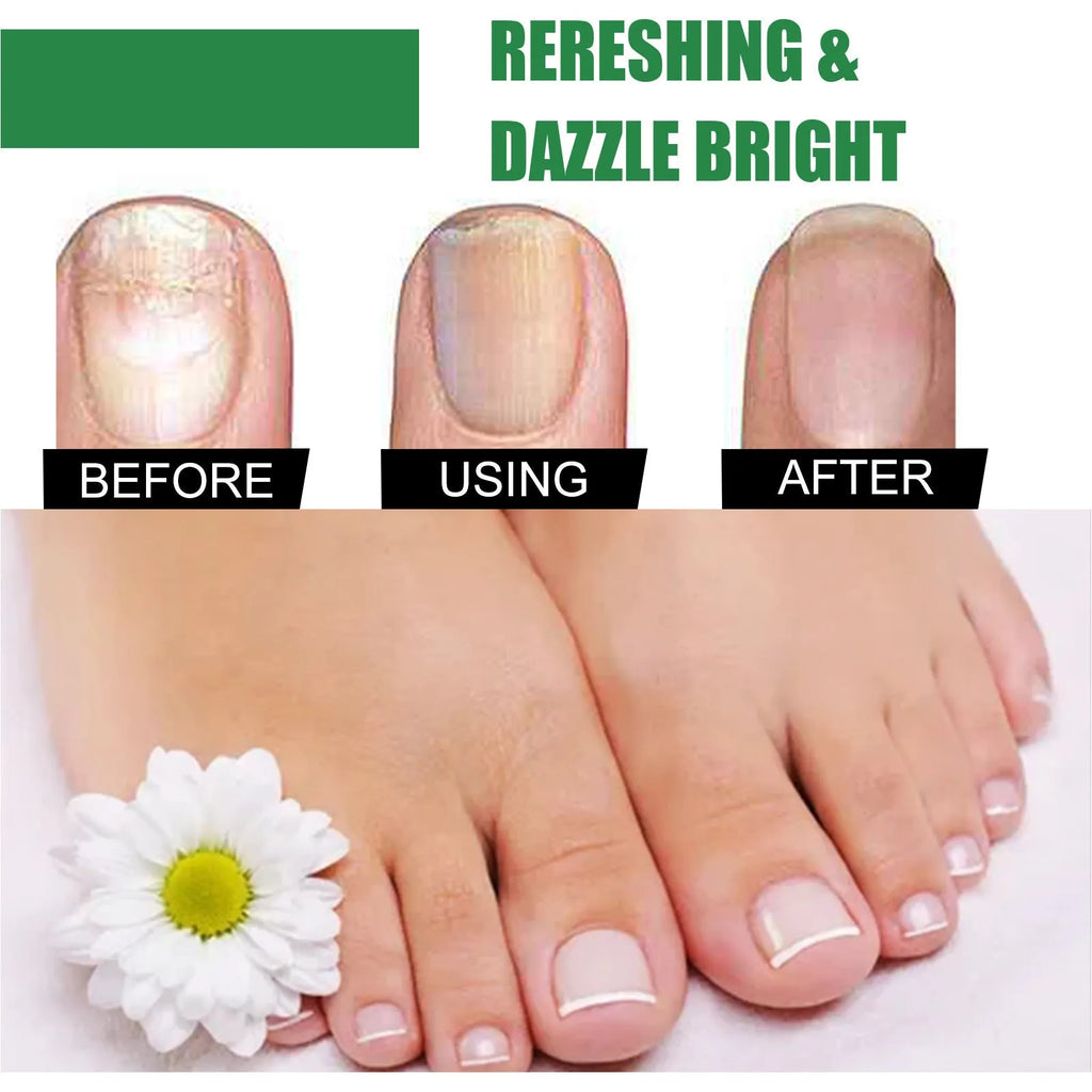 30ml bottle of tea tree oil foot and nail care repair liquid for thick soft nails