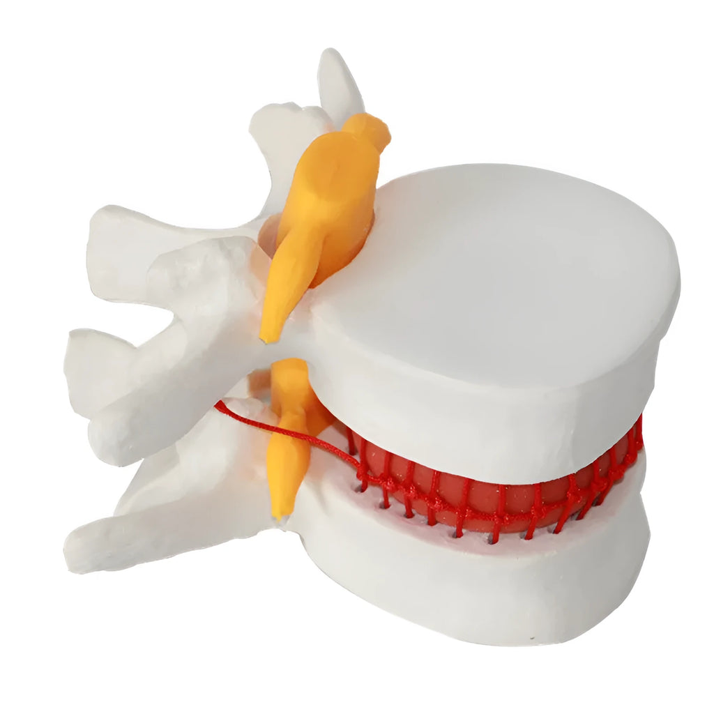 White PVC intervertebral disc herniation demonstration model for medical education