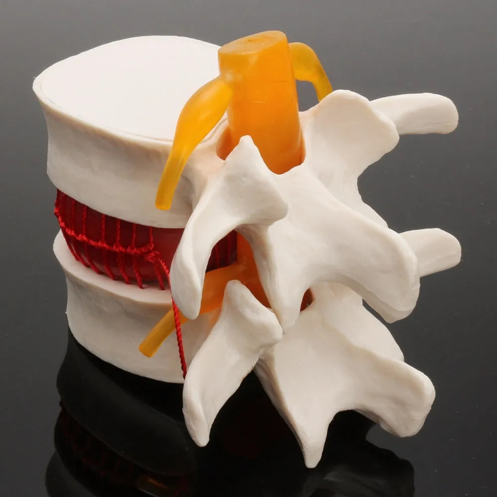 White PVC intervertebral disc herniation demonstration model for medical education