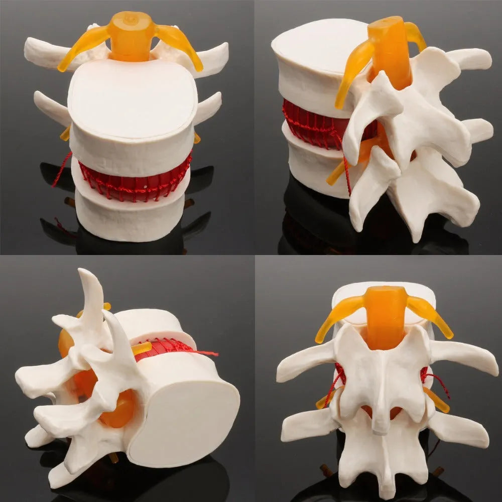 White PVC intervertebral disc herniation demonstration model for medical education