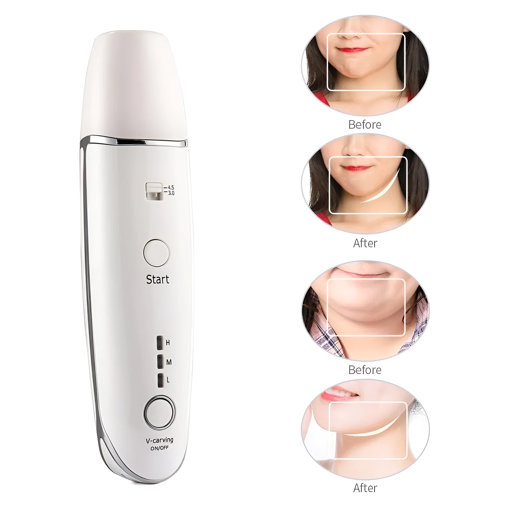Wrinkle removal V-shape anti-aging skin care beauty device with RF HIFU, 17cm ABS, home use